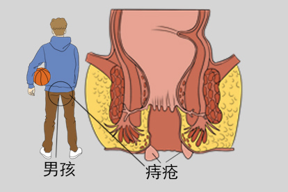 男孩长痔图片