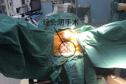 内痔手术治疗图片