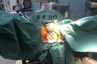 女人长痔手术治疗方法图片