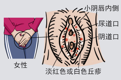 女性珍珠疣图片