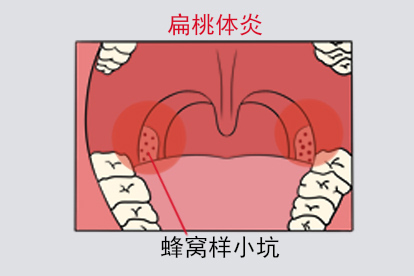 扁桃体蜂窝样小坑图片