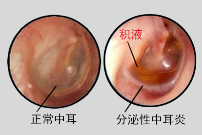 分泌性中耳炎图片