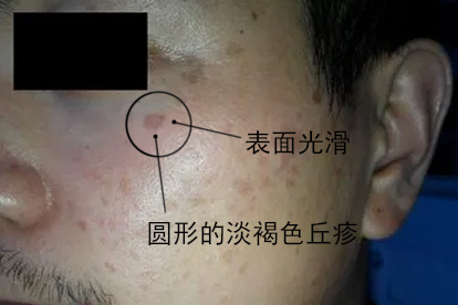 hpv男性感染引起扁平疣脸上图