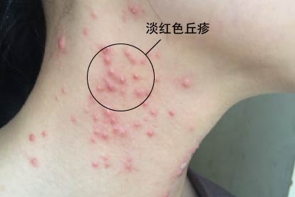 脖子尖锐湿疣症状图