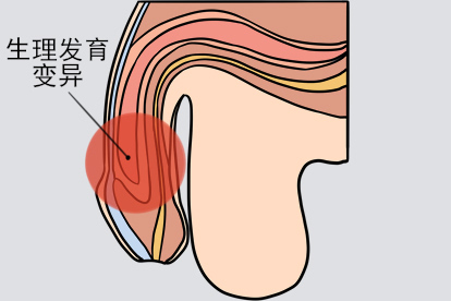 男性珍珠样阴茎丘疹发育变异图