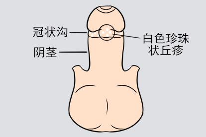 男性珍珠样阴茎丘疹症状图