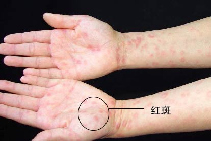 梅毒症状图片