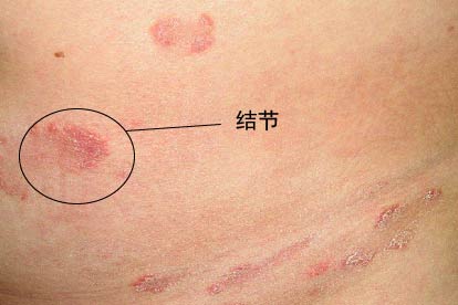 梅毒症状图片