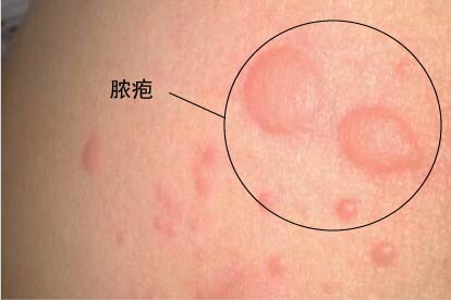 梅毒症状图片