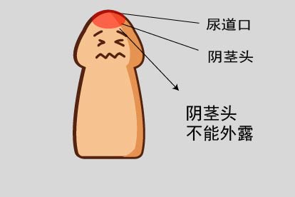 包皮过长图片