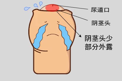 包皮过长图片