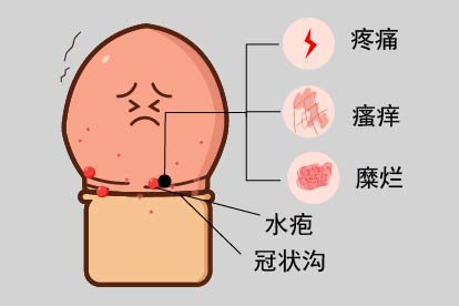 阴茎冠状沟疱疹图片