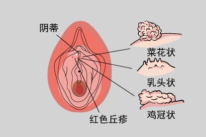 阴蒂尖锐湿疣症状图片