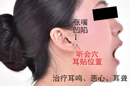 呕吐耳贴听会穴位置示意图