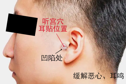 呕吐耳贴听宫穴位置示意图
