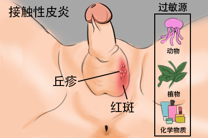 阴囊丘疹图片大全接触性皮炎