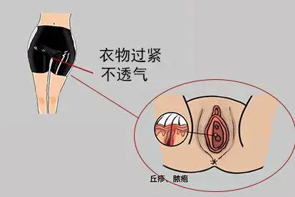 阴道口长了个疙瘩毛囊炎原因
