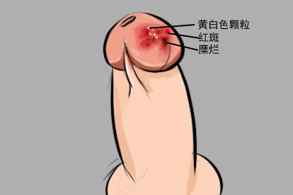 龟头炎图