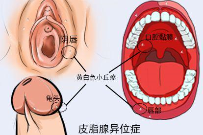 皮脂腺异位症图