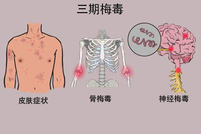 三期梅毒症状图