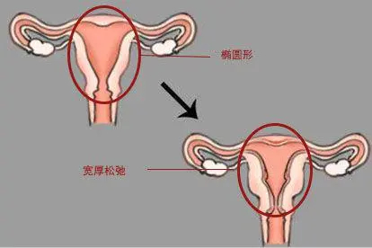 打过胎的子宫形状图片
