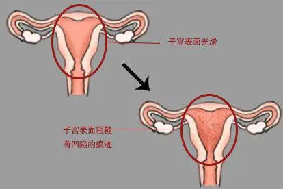 打过胎的子宫结构图片