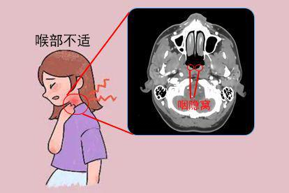 咽隐窝不对称引发的喉部不适图片