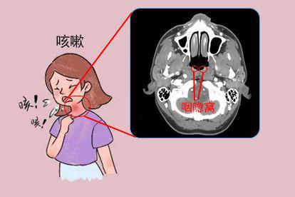 咽隐窝不对称引发的咳嗽图片