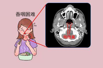 咽隐窝不对称引发的吞咽困难图片