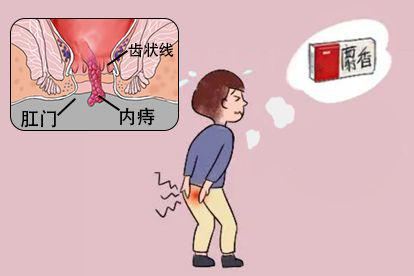内痔脱出肛门外药物治疗图片