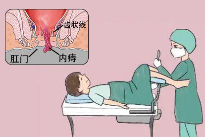 内痔脱出肛门外手术治疗图片