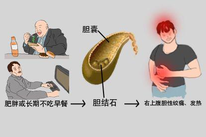 肚脐右侧疼胆结石图片