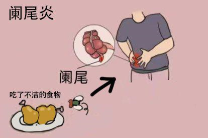 肚脐右侧疼阑尾炎图片