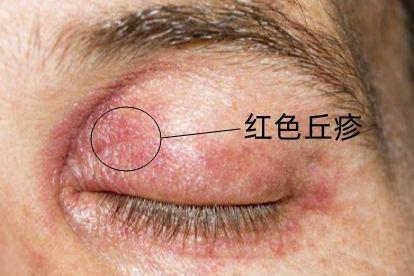 眼皮上毛囊炎图片