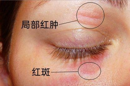 眼皮上过敏性皮炎图片