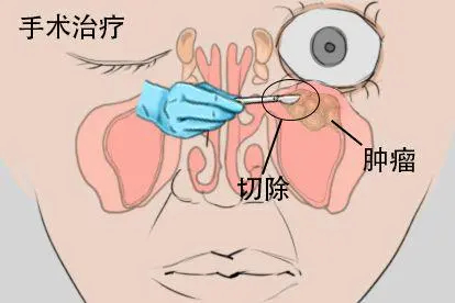 鼻窦癌压迫眼球突出手术治疗图