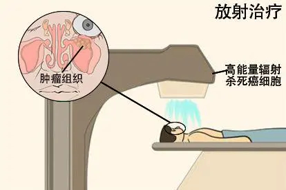 鼻窦癌压迫眼球突出放射治疗图
