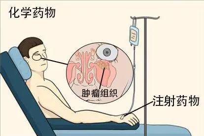 鼻窦癌压迫眼球突出药物治疗图