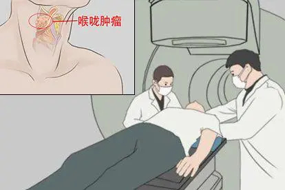 喉咙长肿瘤放疗图片