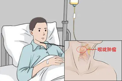 喉咙长肿瘤化疗图片