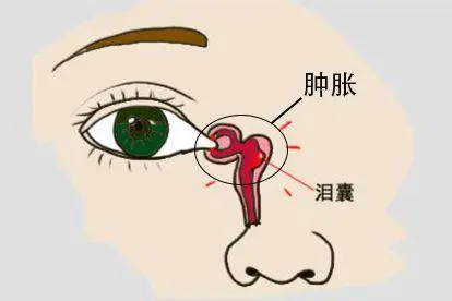 泪囊增生肿胀图