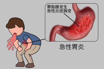 急性胃炎图片