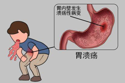 胃溃疡图片