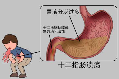 十二指肠溃疡图片