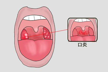 喉咙有疱疹口炎图片
