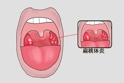 喉咙有疱疹扁桃体炎图片