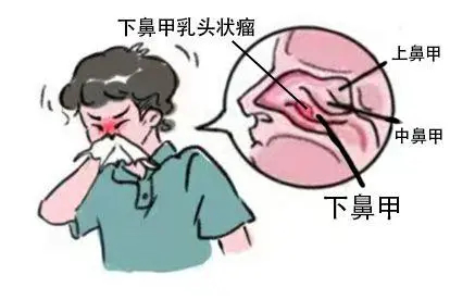 下鼻甲乳头状瘤流鼻涕图片