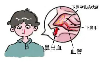 下鼻甲乳头状瘤鼻出血图片