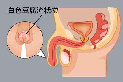 包皮污垢图片