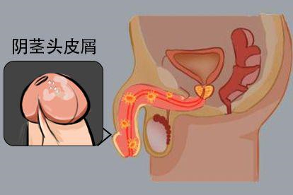 干燥闭塞性龟头炎图片